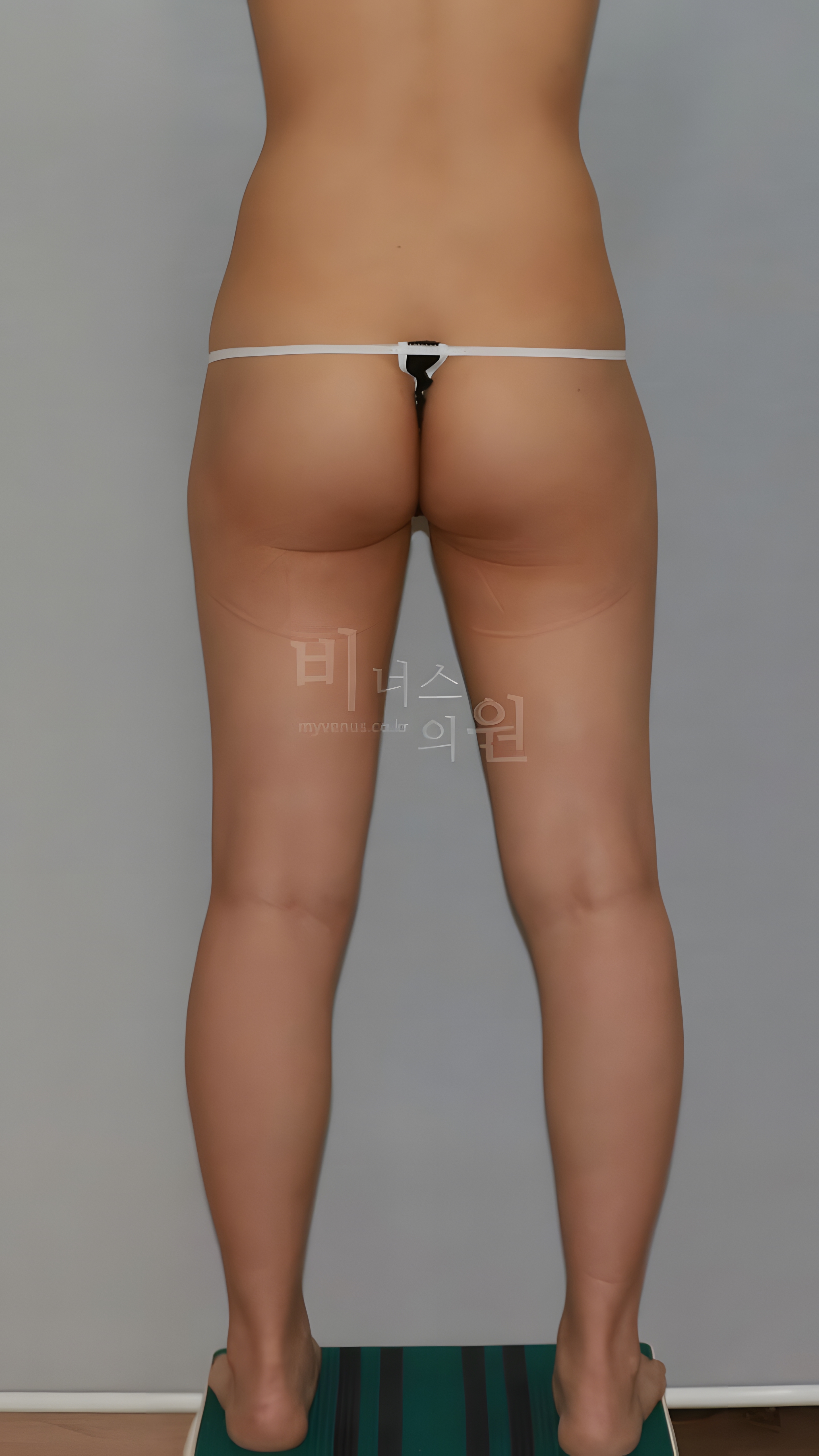 엉덩이 볼륨업 지방흡입 수술 전 후면 비너스의원