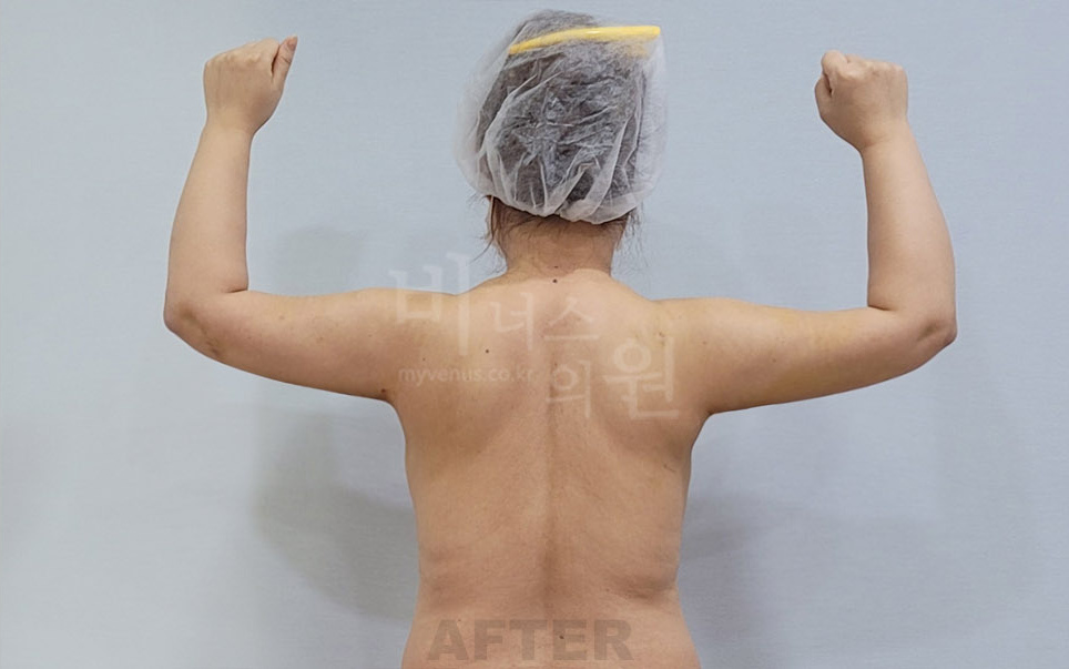 팔 지방흡입 수술 후 후면 팔 올림 자세 비너스의원