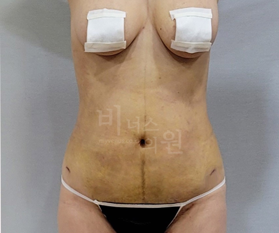 복부 지방흡입 수술 후 정면 비너스의원