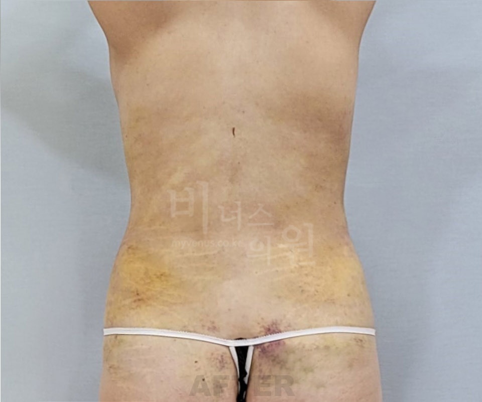 복부 지방흡입 수술 후 후면 비너스의원