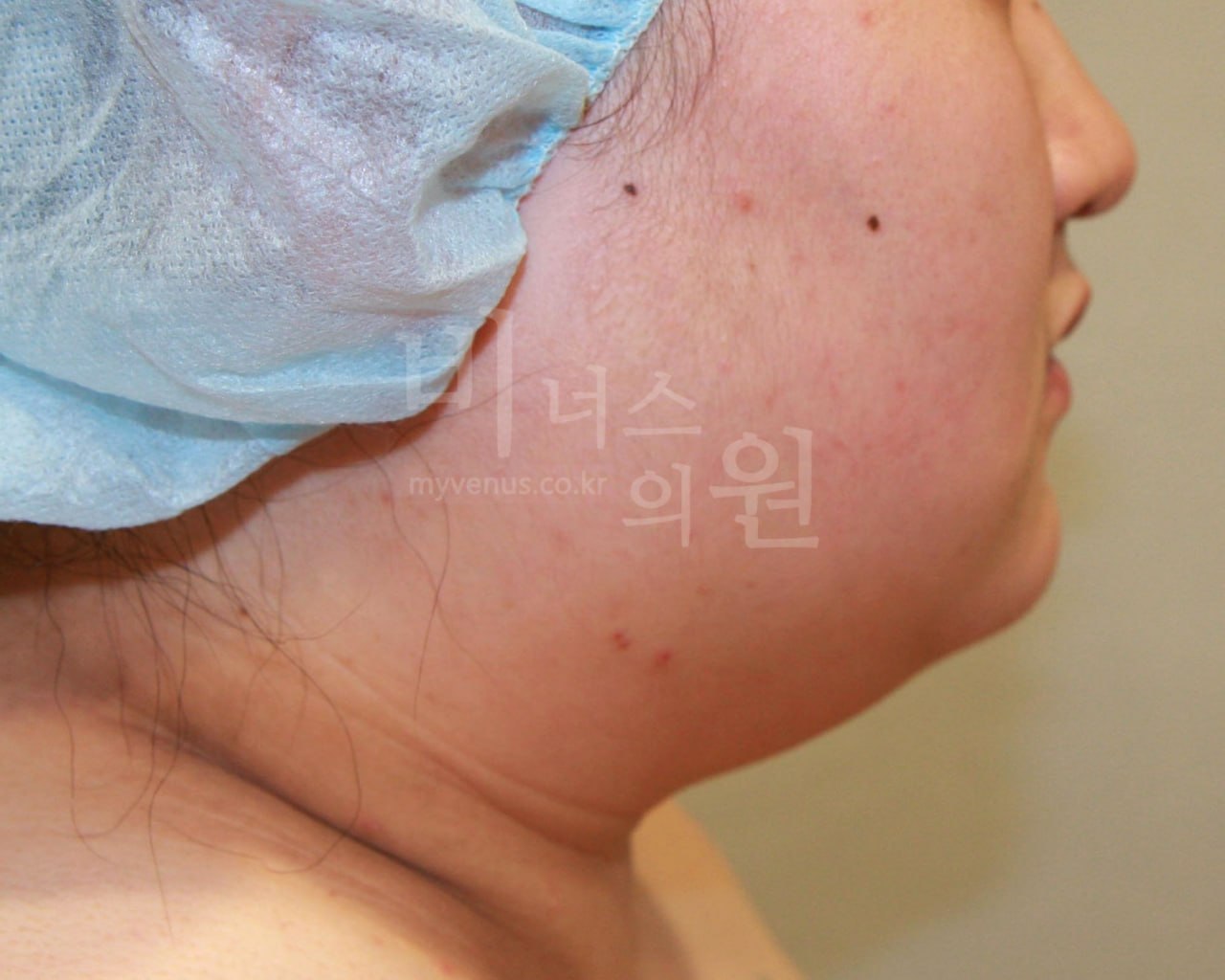 턱지방흡입 전후 사례3 수술 전 비너스의원