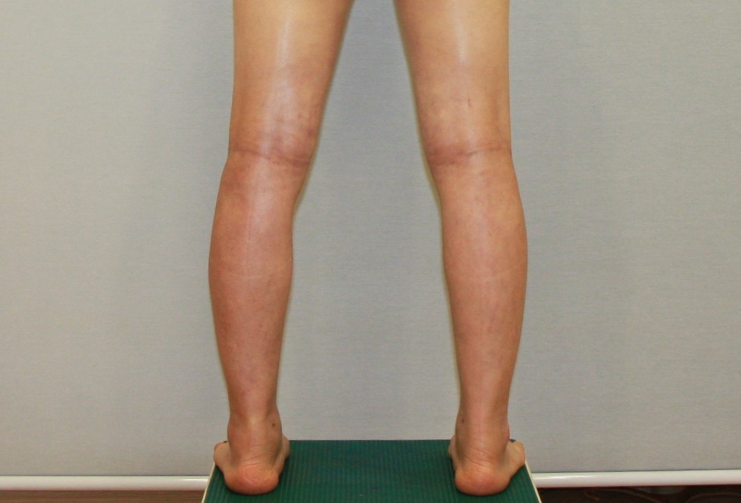 종아리지방흡입 종아리근육퇴축 종아리알 수술후 4주 경과 후기.JPG