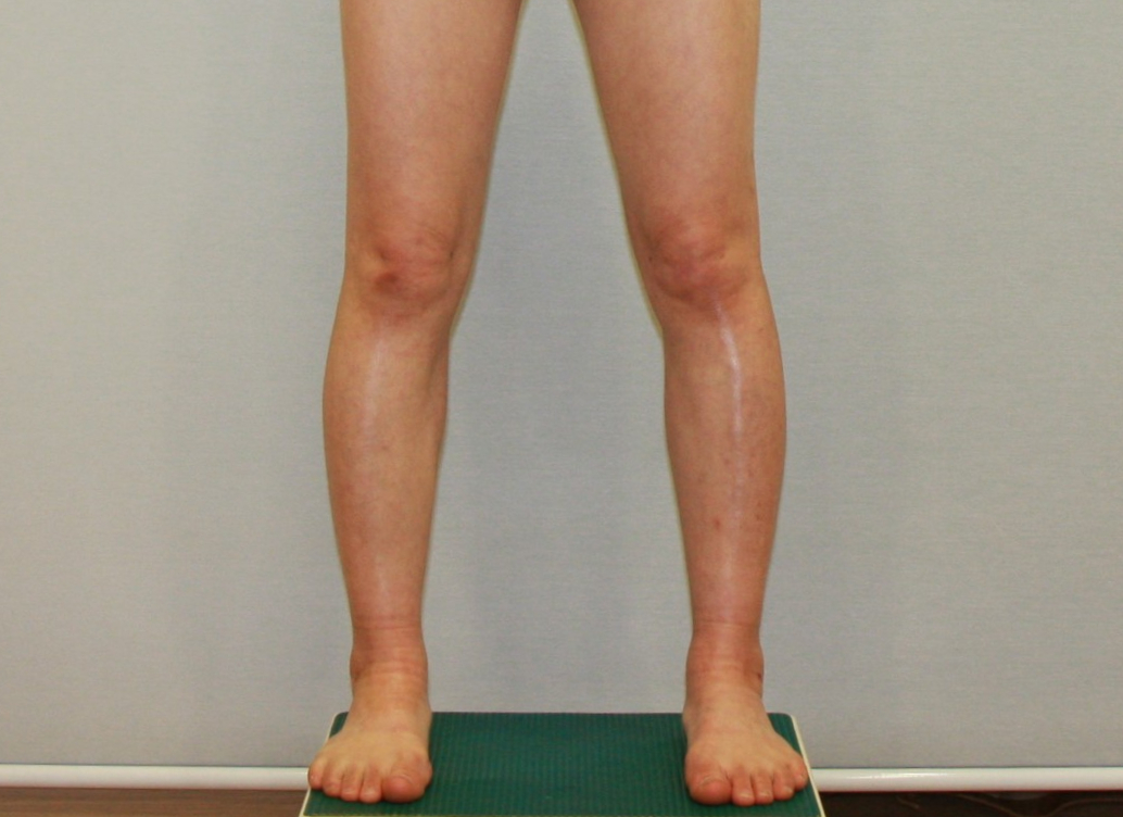 종아리지방흡입 종아리알 종아리근육 종아리 수술후 한달 4주 후기.jpg