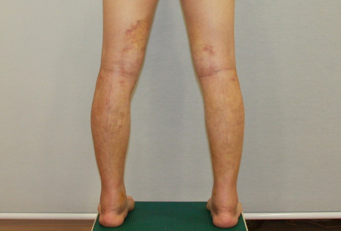 종아리지방흡입 종아리근육퇴축 종아리알 수술후 1주 경과 후기.JPG