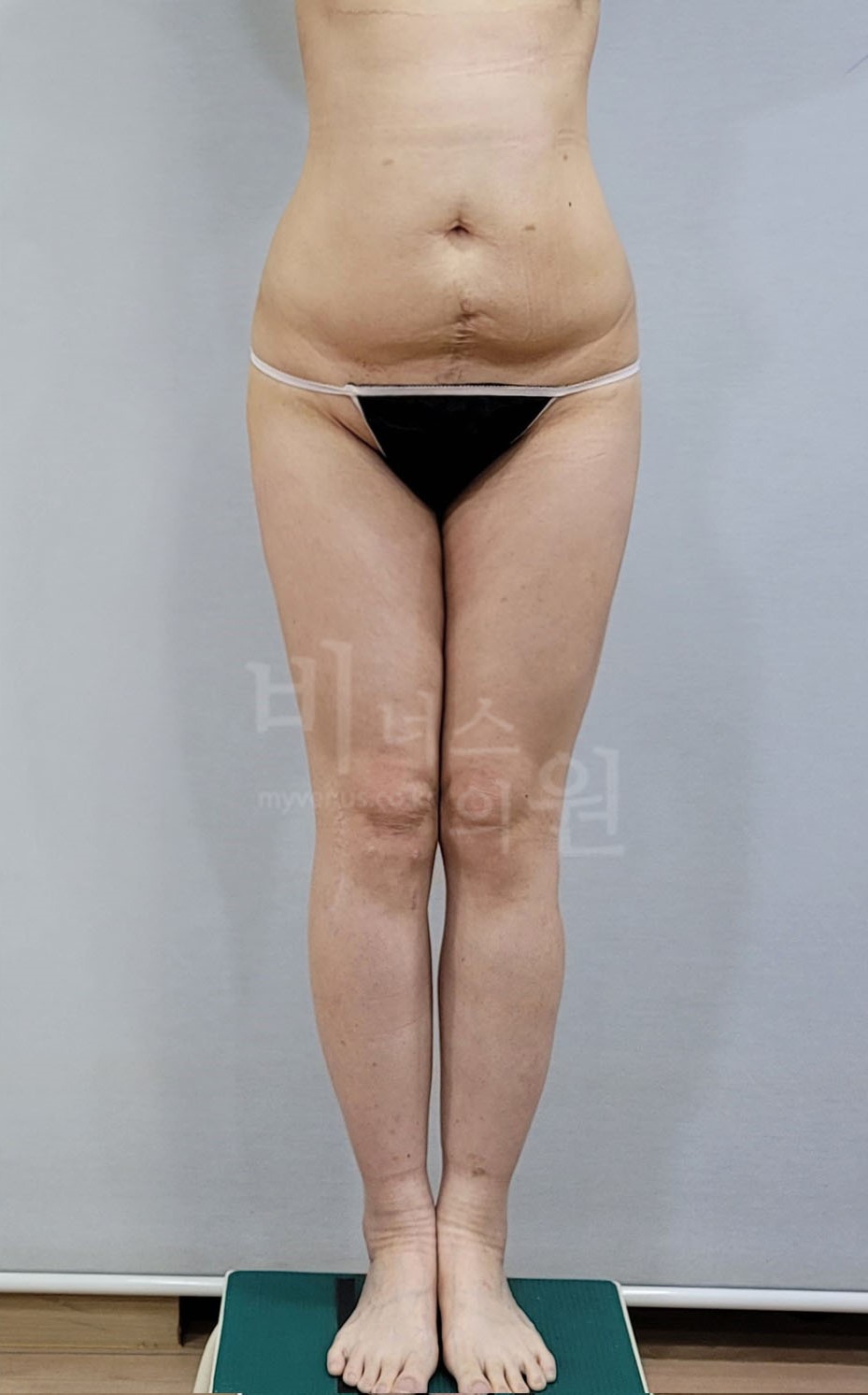 엉덩이축소 지방흡입 수술 후 정면 비너스의원