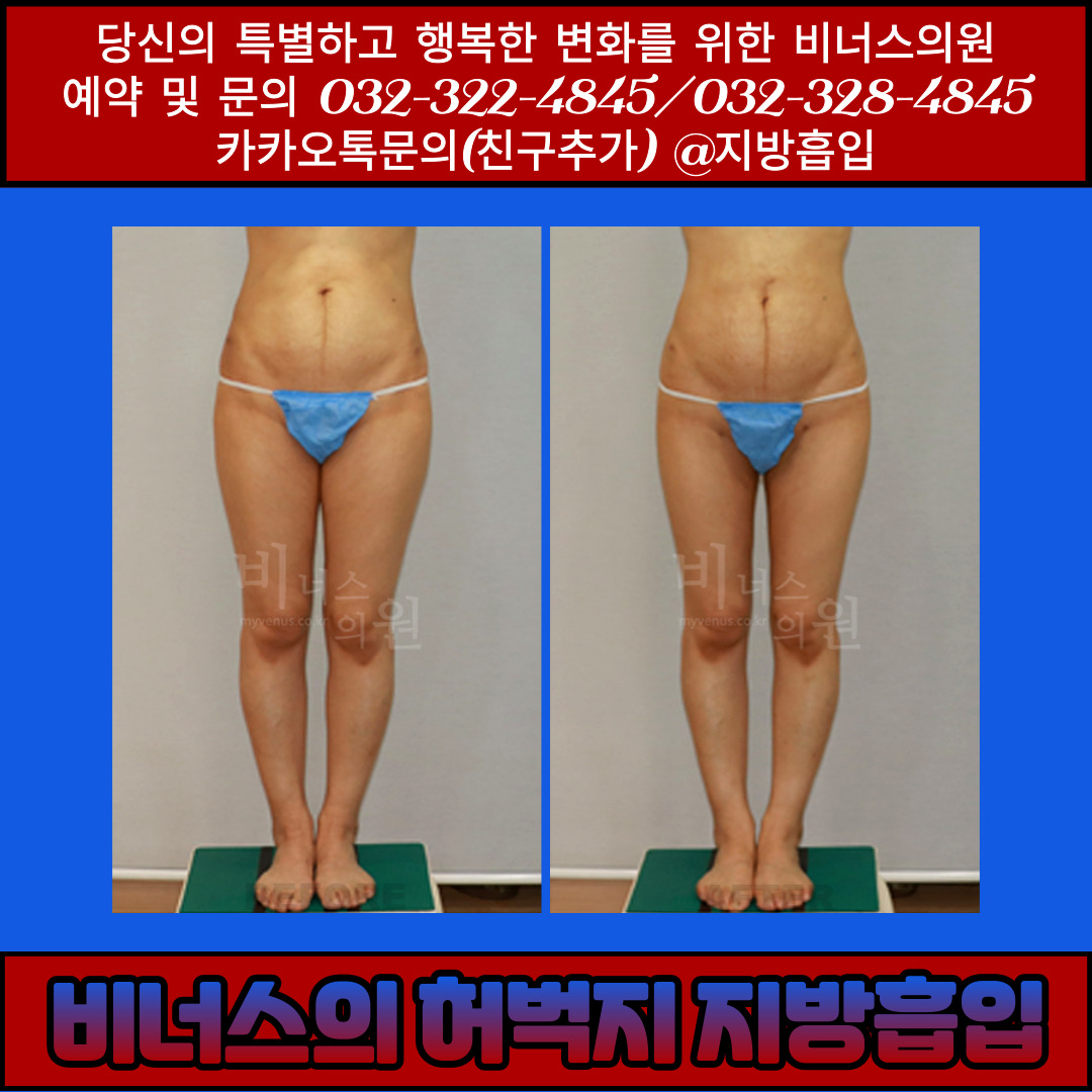 허벅지지방흡입-006.jpg