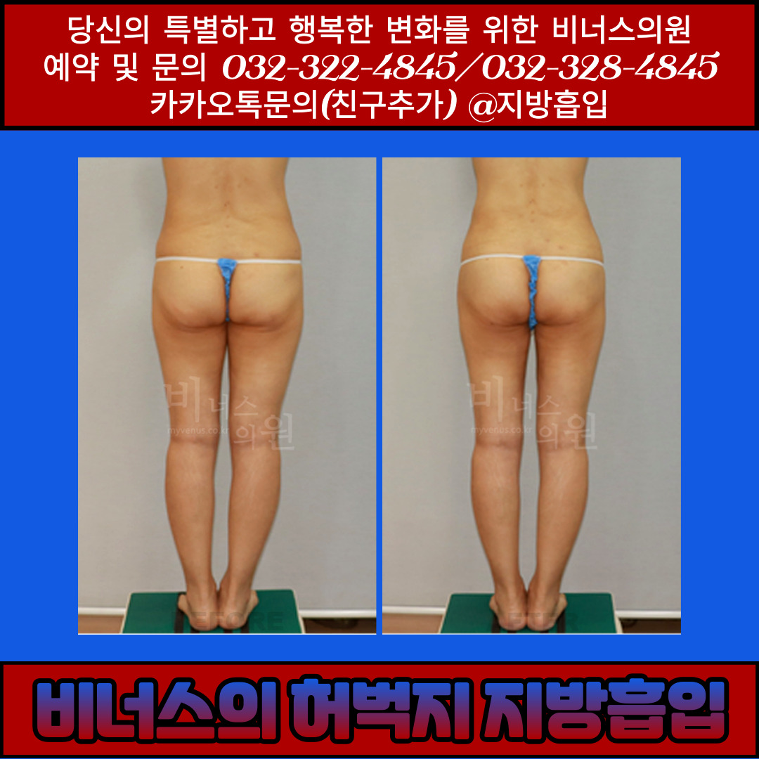 허벅지지방흡입-006 (2).jpg