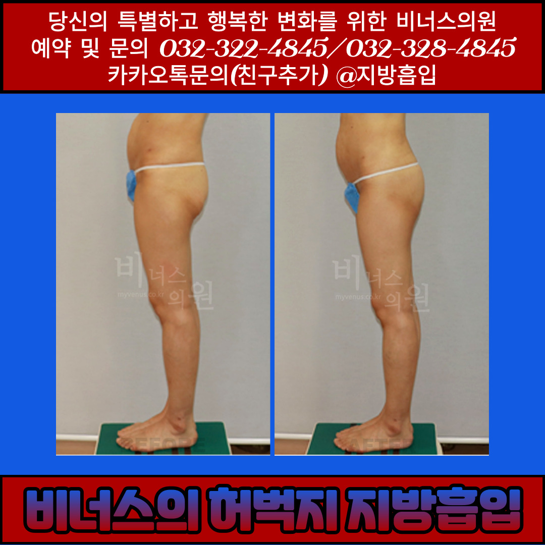 허벅지지방흡입-006 (1).jpg