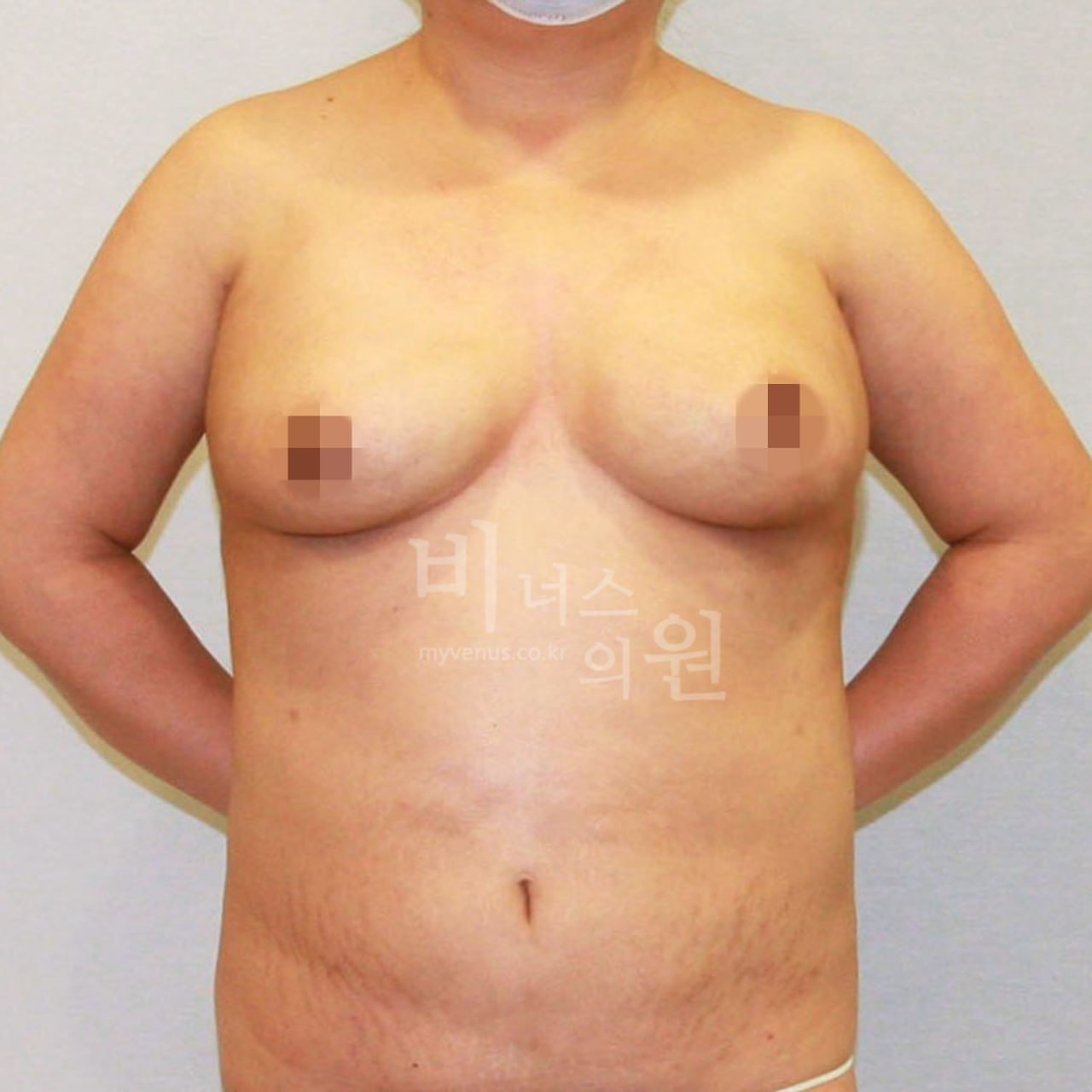 가슴축소 지방흡입 수술 후 정면