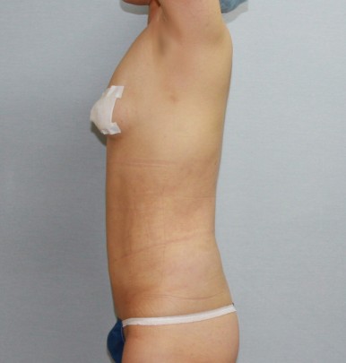 복부지방흡입 수술 후 좌측 모습.jpg
