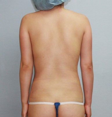 복부지방흡입 수술 후 뒷모습.jpg