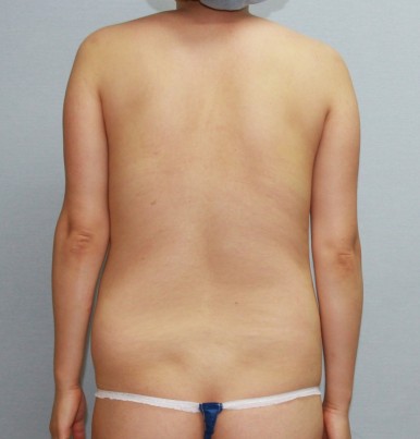 복부지방흡입 수술 전 뒷모습.jpg
