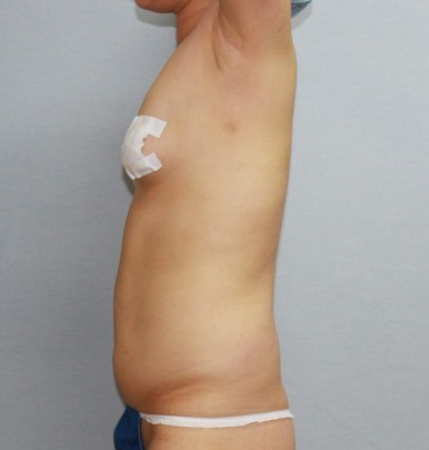 복부지방흡입 수술 전 좌측 모습.jpg