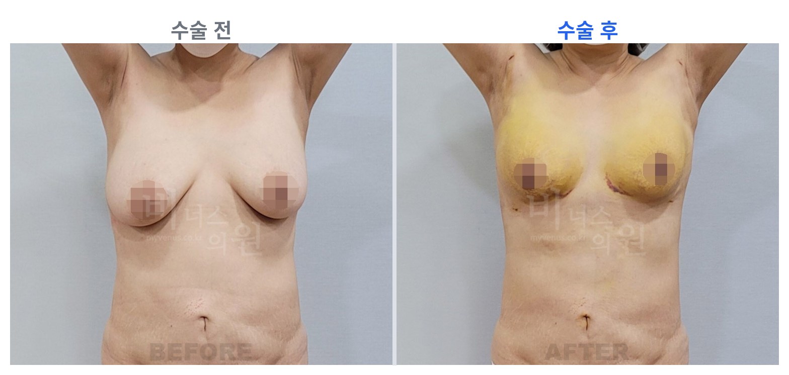 유방하수 표층 지방흡입 수술 전후 정면 비교 비너스의원