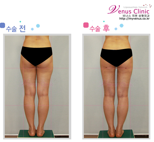 허벅지지방흡입1_3.jpg