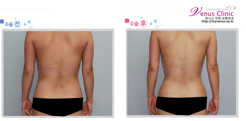 복부지방흡입1_2.jpg