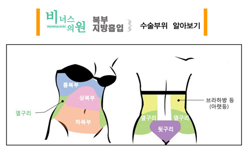 비너스의-복부지방흡입-부위-섹션.jpg