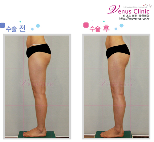 허벅지지방흡입1_2.jpg