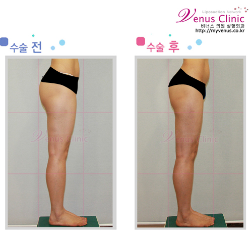 허벅지지방흡입1_1.jpg