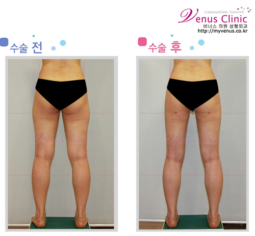 허벅지지방흡입1_4.jpg