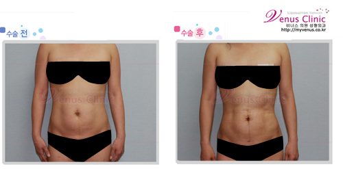 복부지방흡입1.jpg