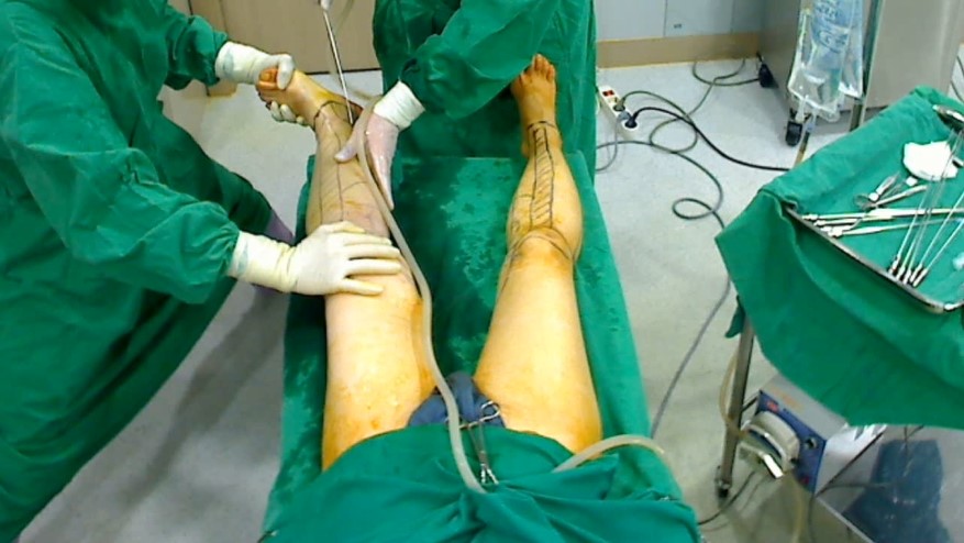 지방흡입 수술 과정 — 투메슨트 방식 적용