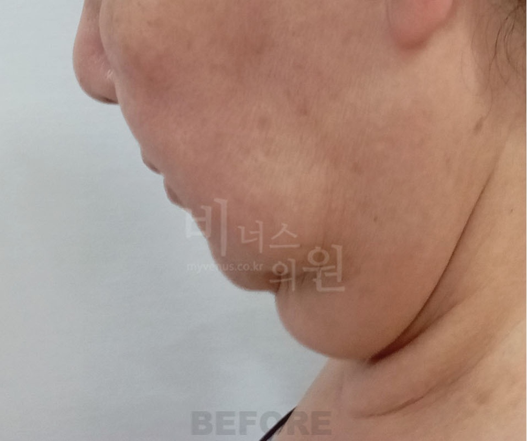 볼 이중턱 지방흡입 수술 전 비너스의원