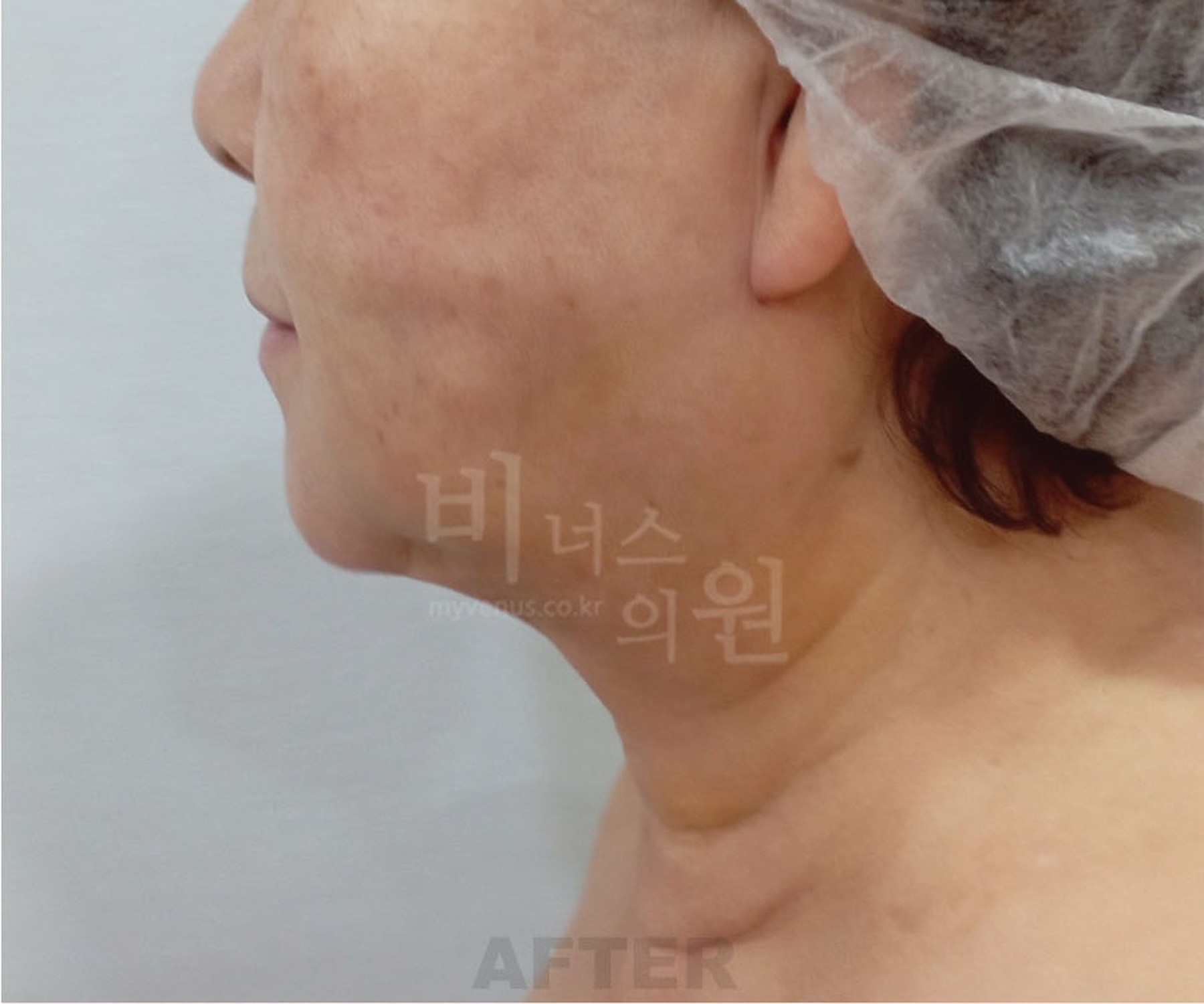 이중턱 지방흡입 수술 후 비너스의원