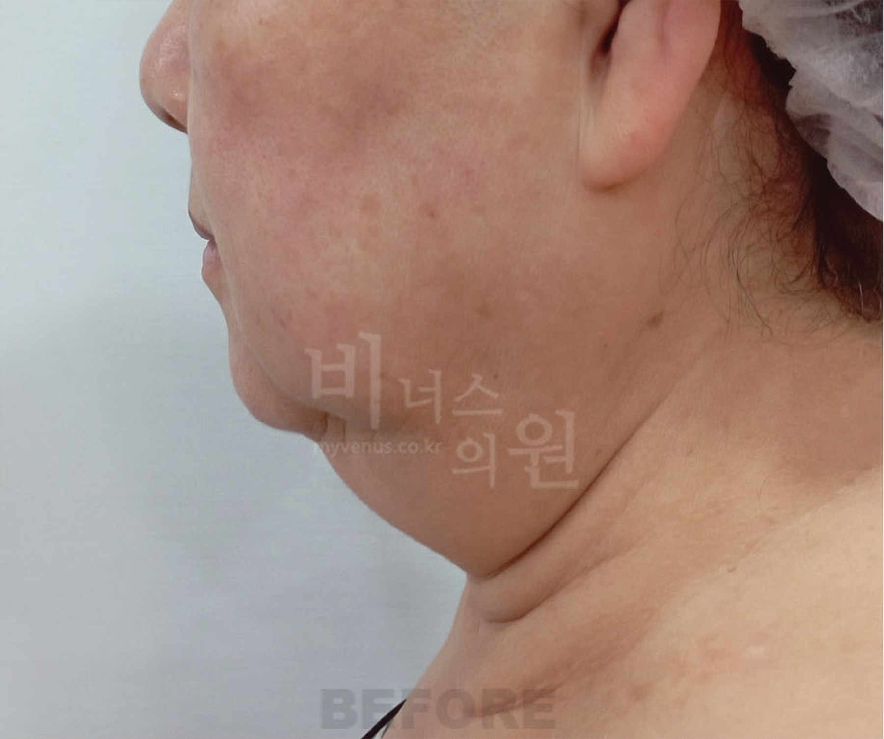 이중턱 지방흡입 수술 전 비너스의원