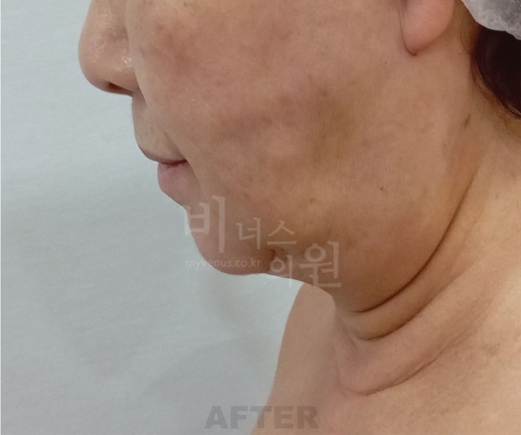볼 이중턱 지방흡입 수술 후 비너스의원