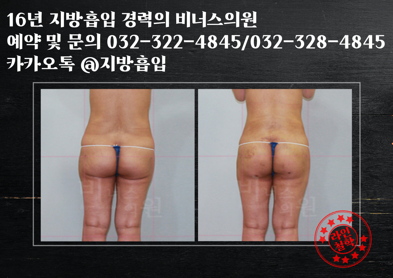 엉덩이볼륨업지방흡입-005.jpg