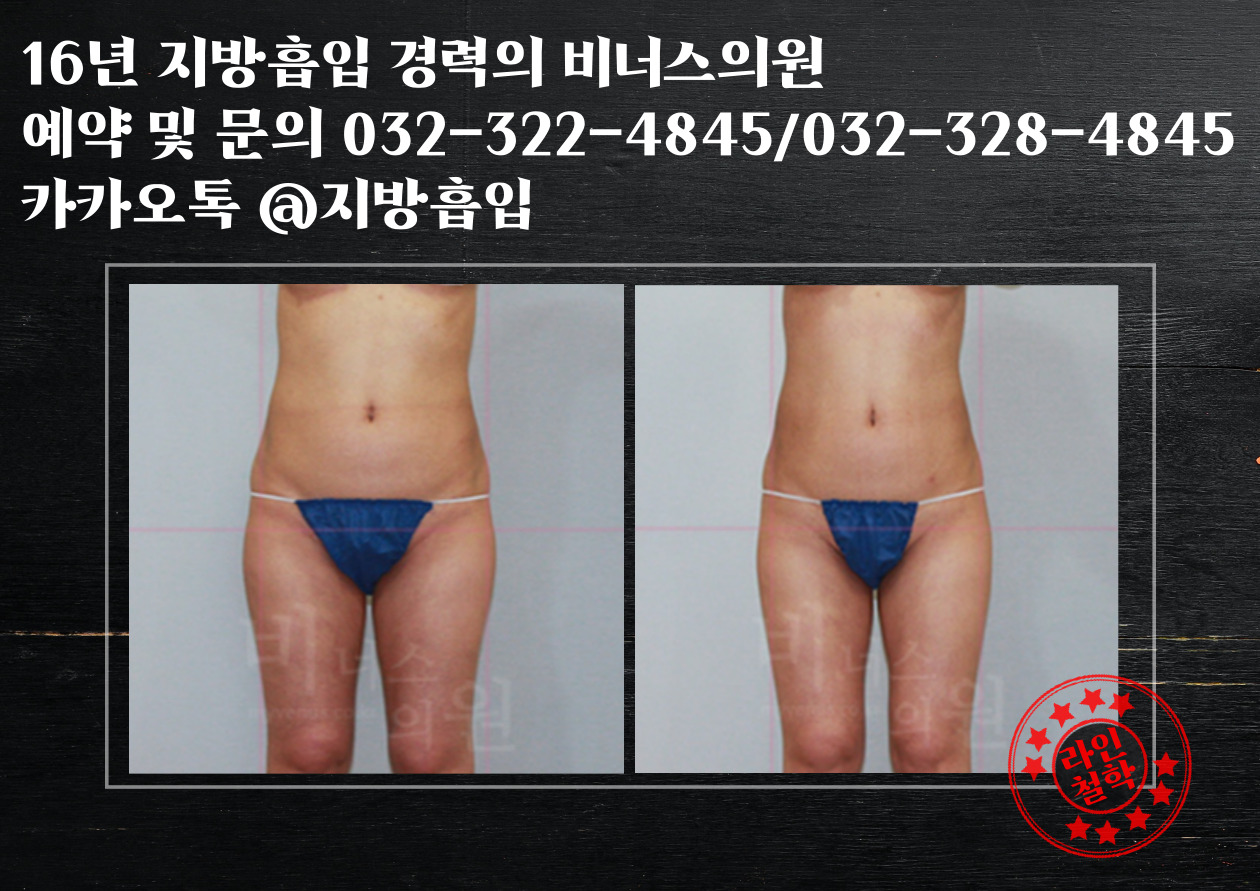 엉덩이볼륨업지방흡입-005 (2).jpg