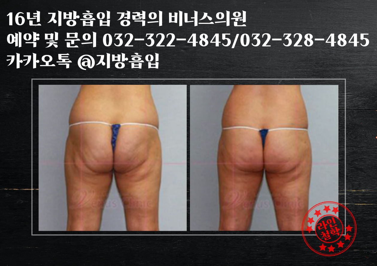 엉덩이볼륨업지방흡입-006.jpg