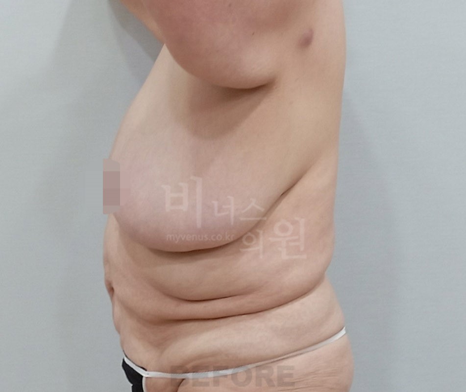 유방하수 표층 지방흡입 수술 전 측면 비너스의원