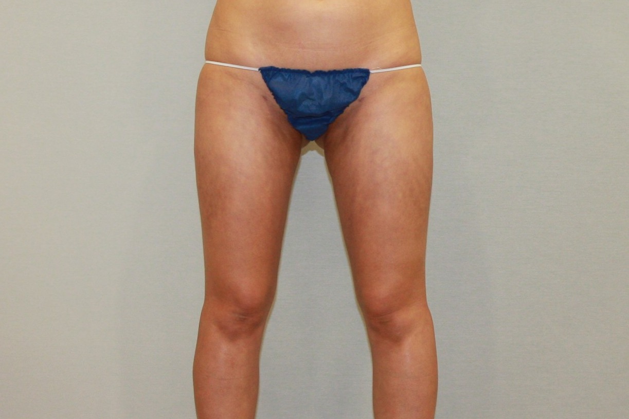 허벅지지방흡입 허벅지안쪽살지방흡입 허벅지승마살지방흡입 승마살지방흡입 허벅지내측지방흡입 허벅지외측지방흡입 허벅지미니지방흡입 허벅지안쪽살지방흡입효과 승마살지방흡입효과 허벅지안쪽살지방흡입경과후기 승마살지방흡입경과후기 허벅지안쪽살지방흡입부작용 승마살지방흡입부작용