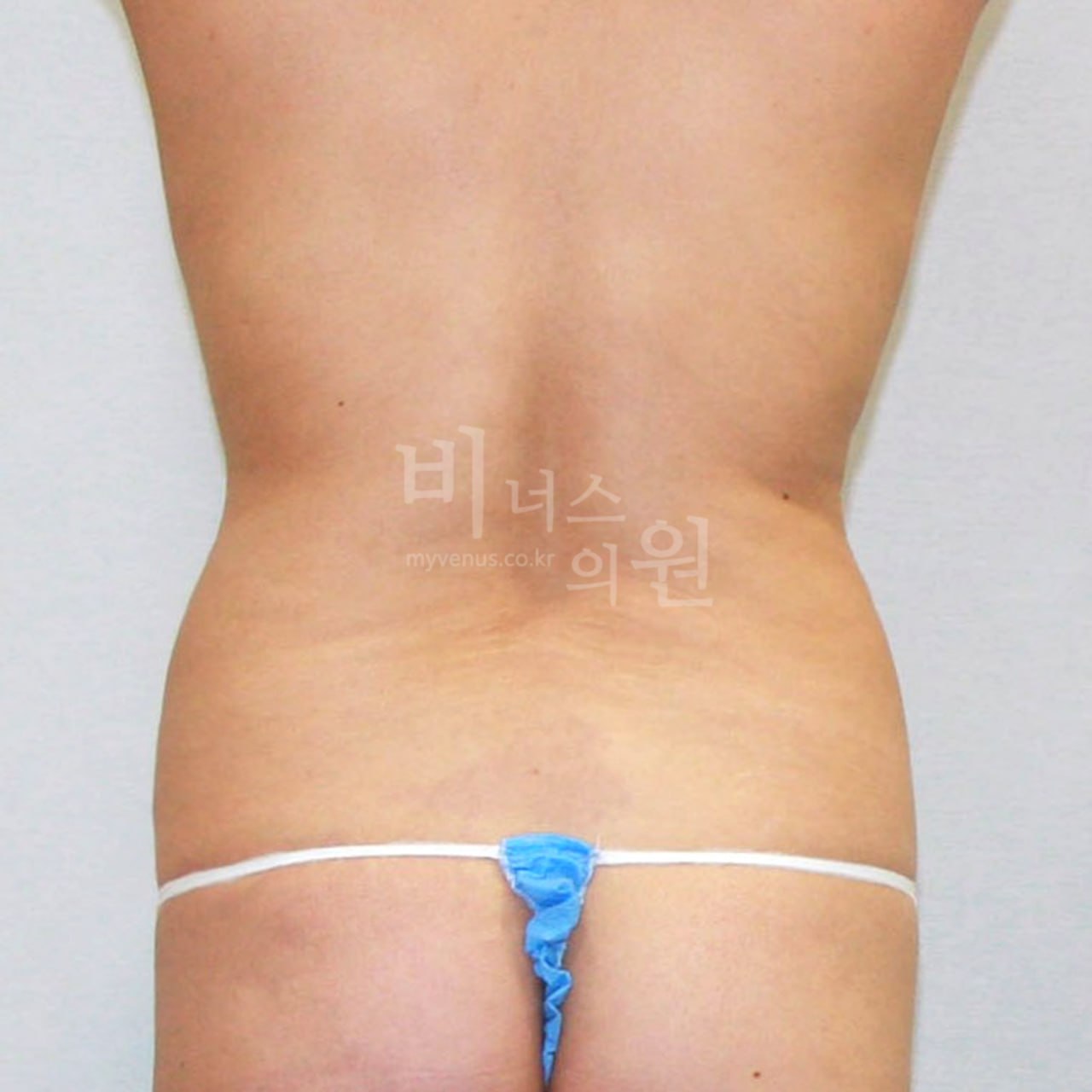 복부지방흡입 수술전 후면 비너스의원