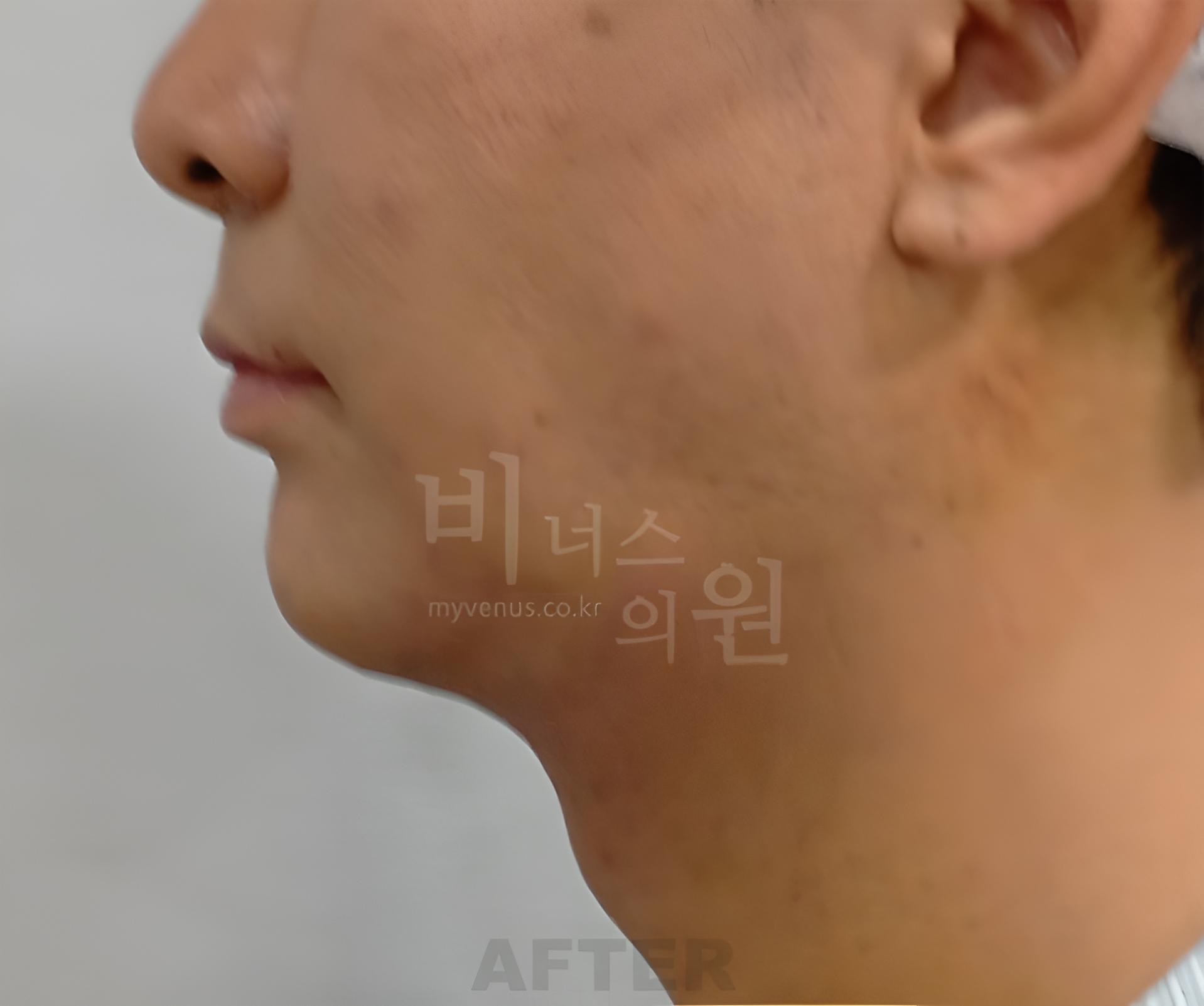 이중턱 지방흡입 수술 후 측면 사진, 턱 아래 윤곽과 목선 비너스의원