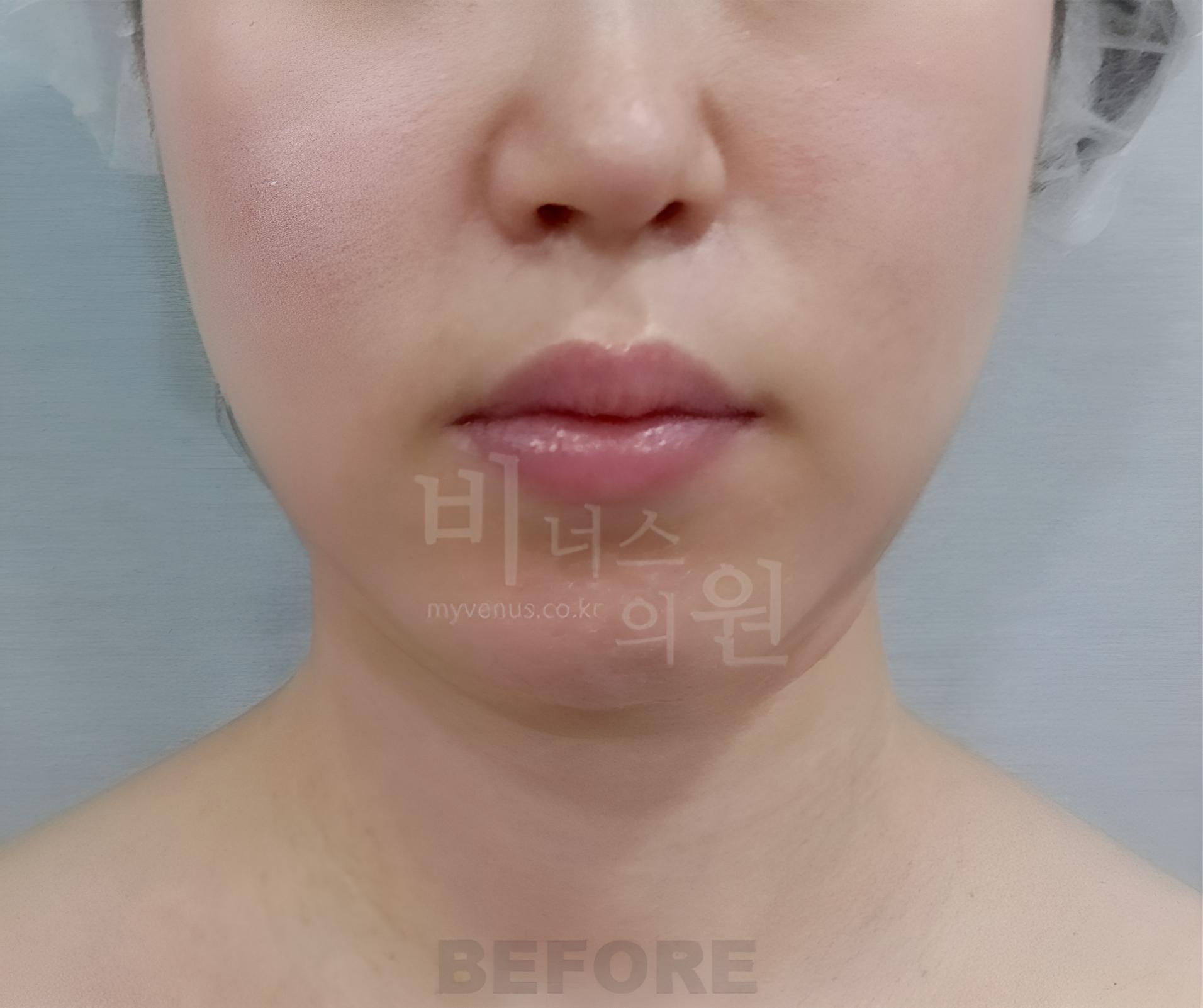 이중턱 지방흡입 수술 전 정면 사진, 턱 아래 둥근 볼륨 비너스의원