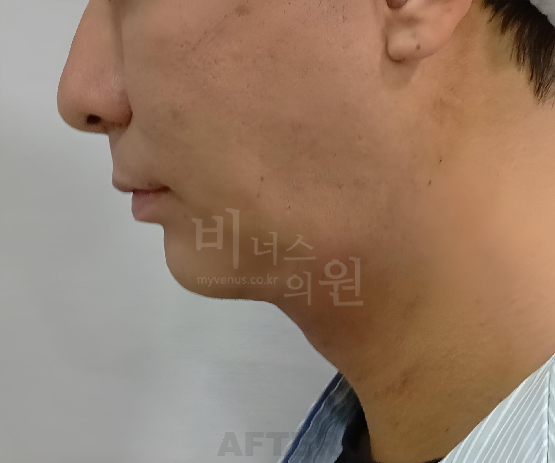 이중턱 지방흡입 수술 후 왼쪽 측면 근접 사진 비너스의원