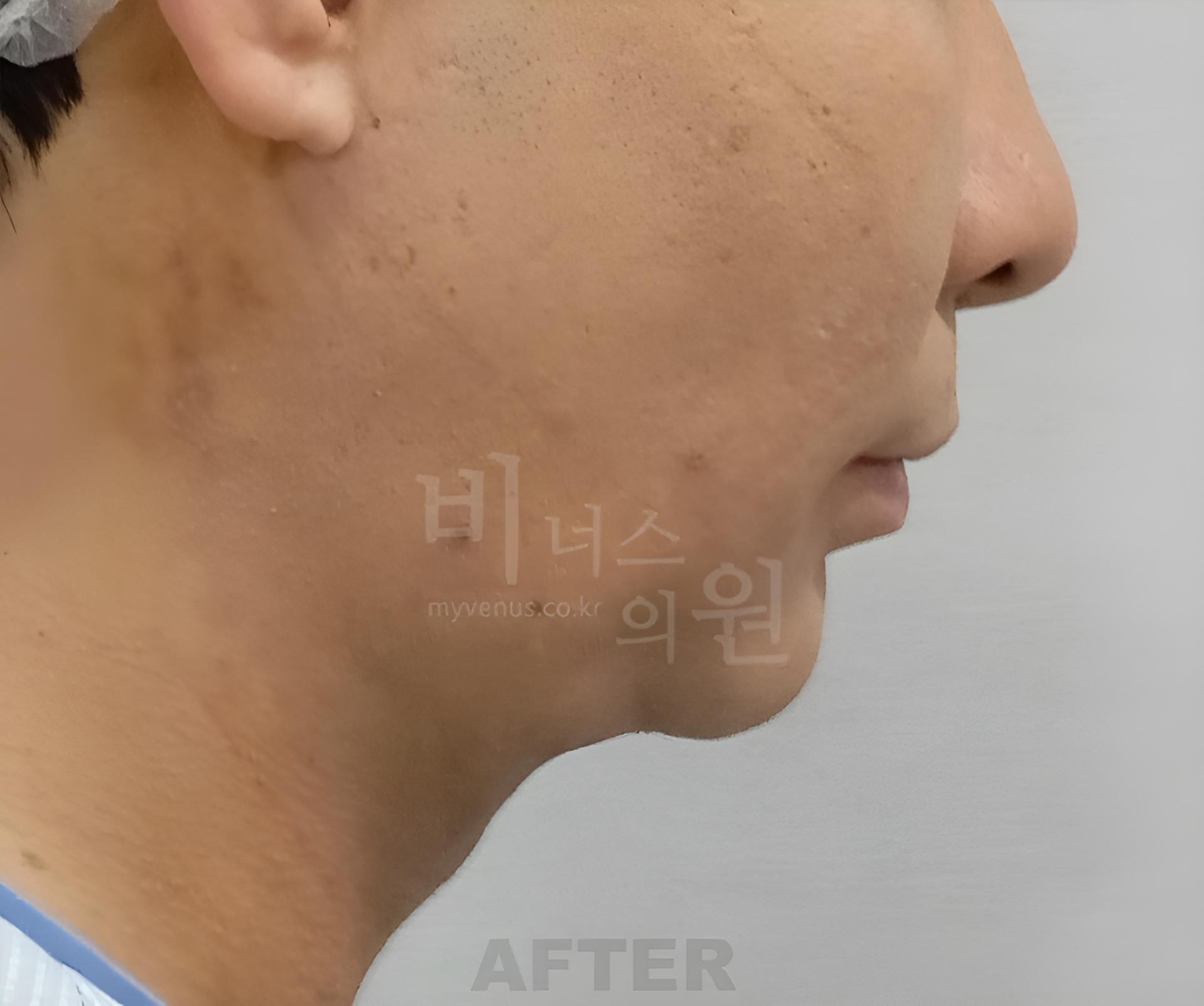 이중턱 지방흡입 수술 후 오른쪽 측면 사진, 정리된 턱 아래 윤곽 비너스의원