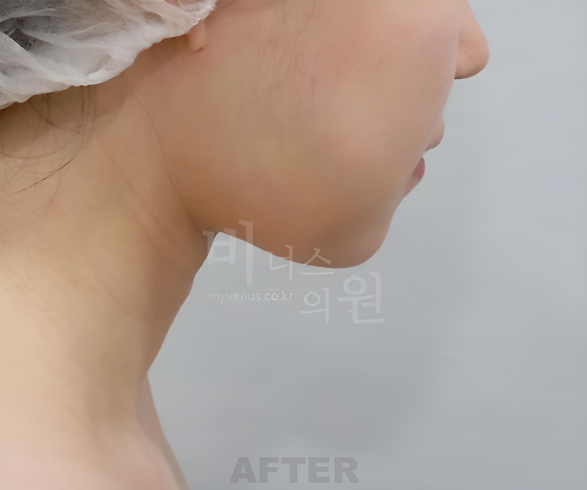 이중턱 지방흡입 수술 후 오른쪽 측면 사진, 턱선과 목선 비너스의원