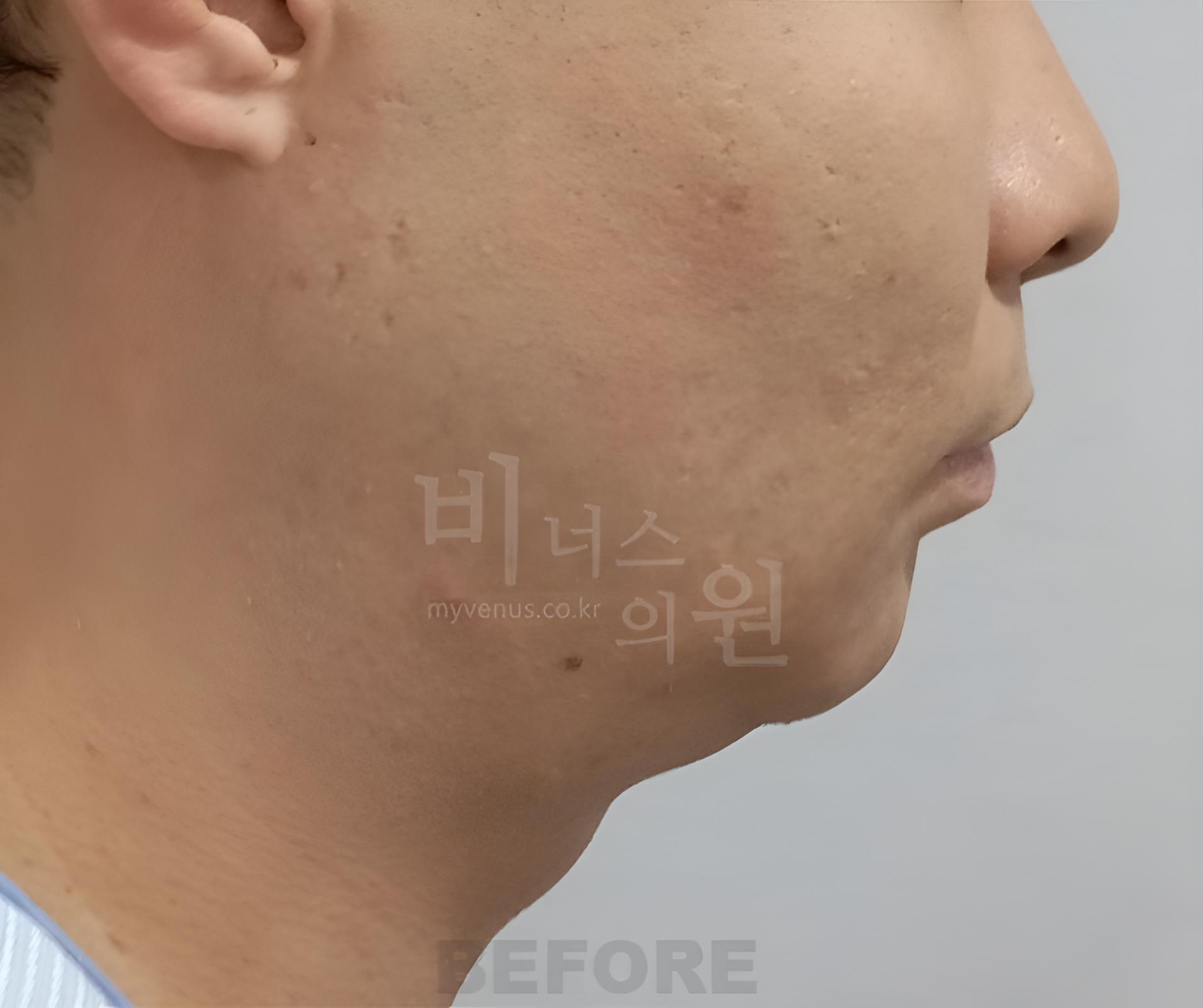 이중턱 지방흡입 수술 전 오른쪽 측면 사진, 턱과 목 경계 비너스의원