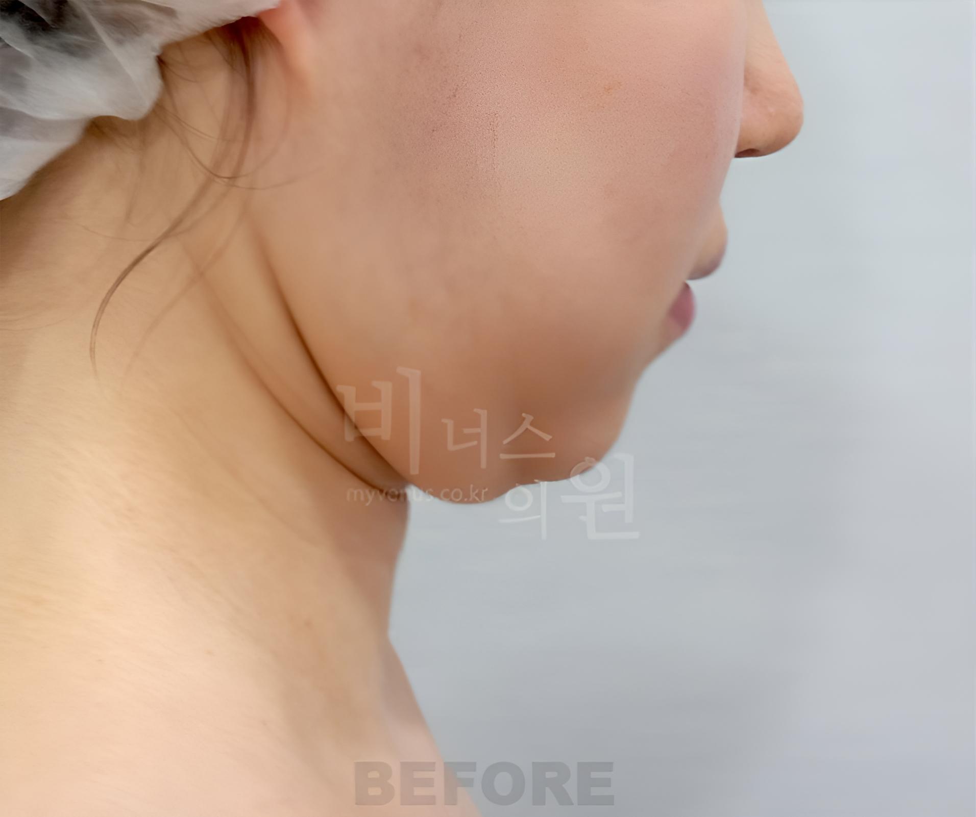 이중턱 지방흡입 수술 전 오른쪽 측면 사진, 턱 밑 볼륨 비너스의원