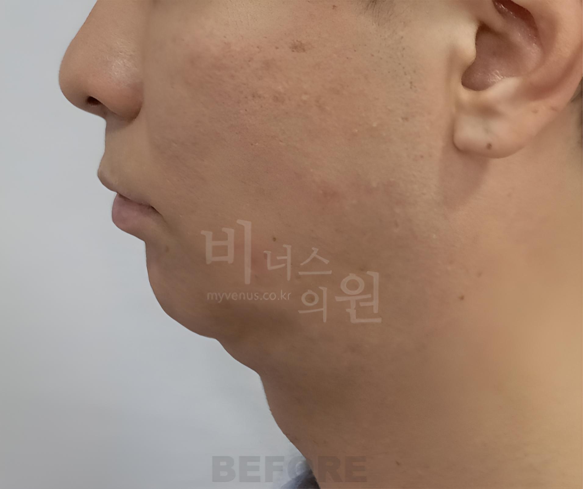 이중턱 지방흡입 수술 전 측면 사진, 턱 아래 둥근 윤곽 비너스의원