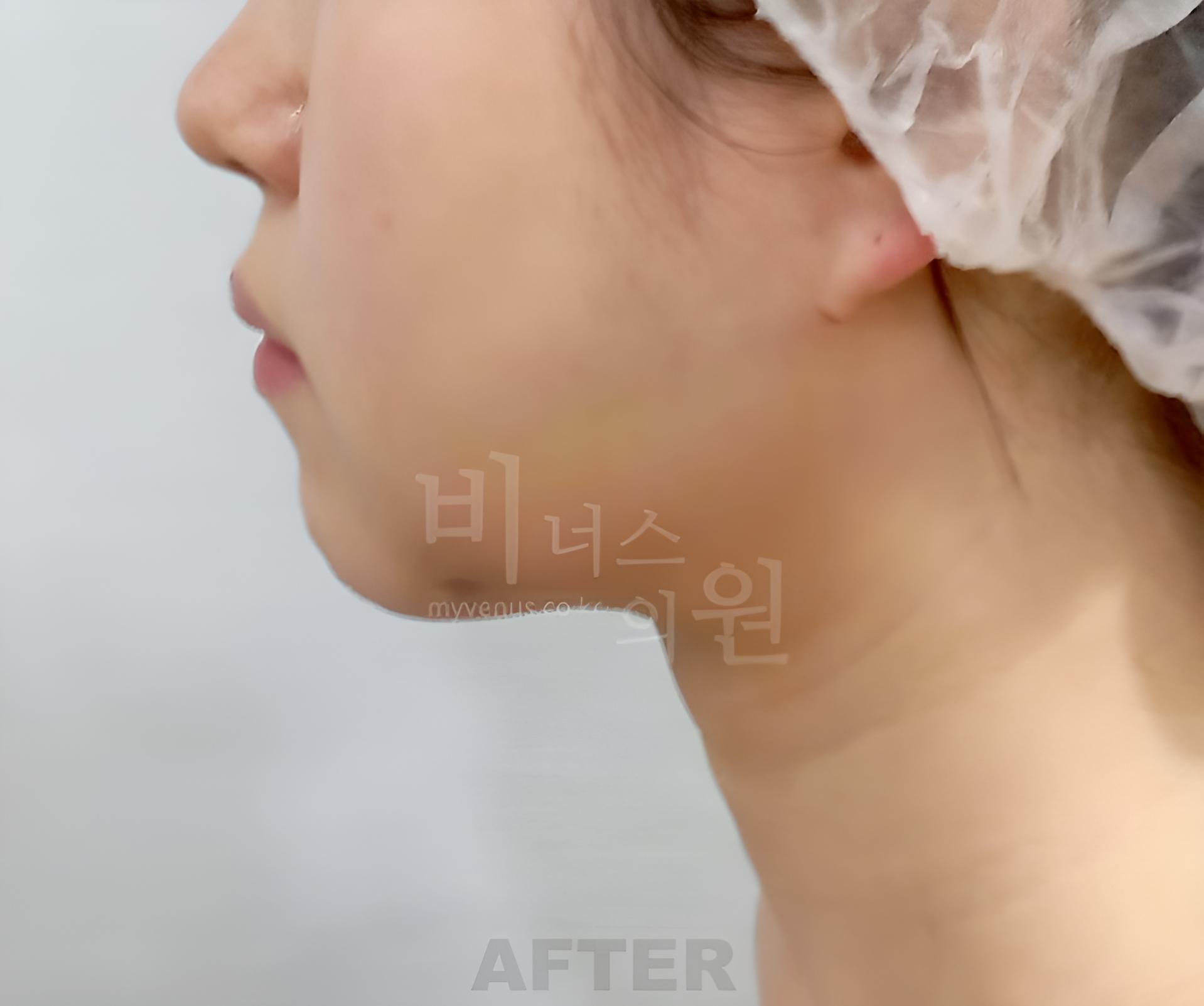 이중턱 지방흡입 수술 후 측면 사진, 턱선과 목선의 경계 비너스의원