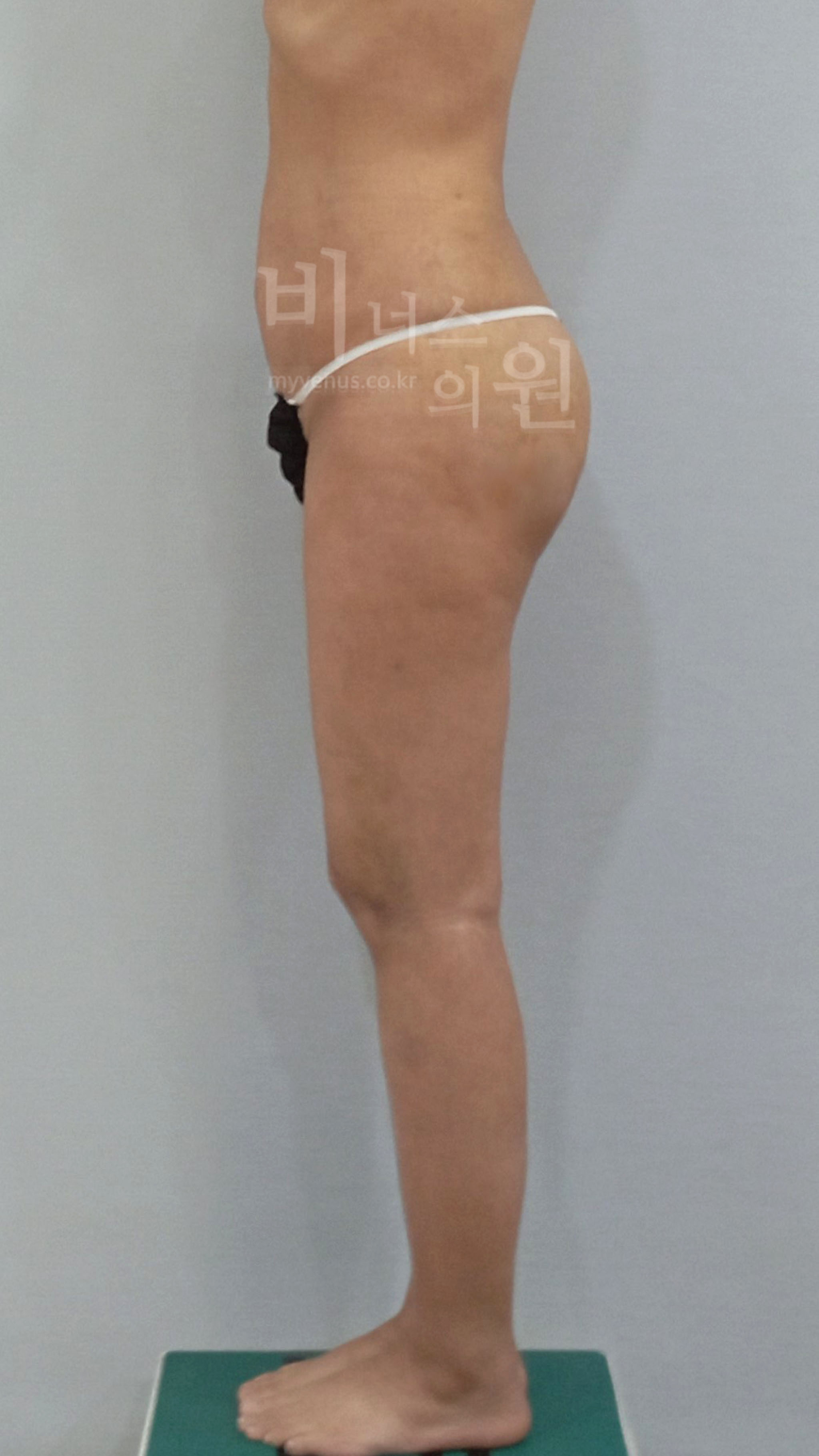 엉덩이축소