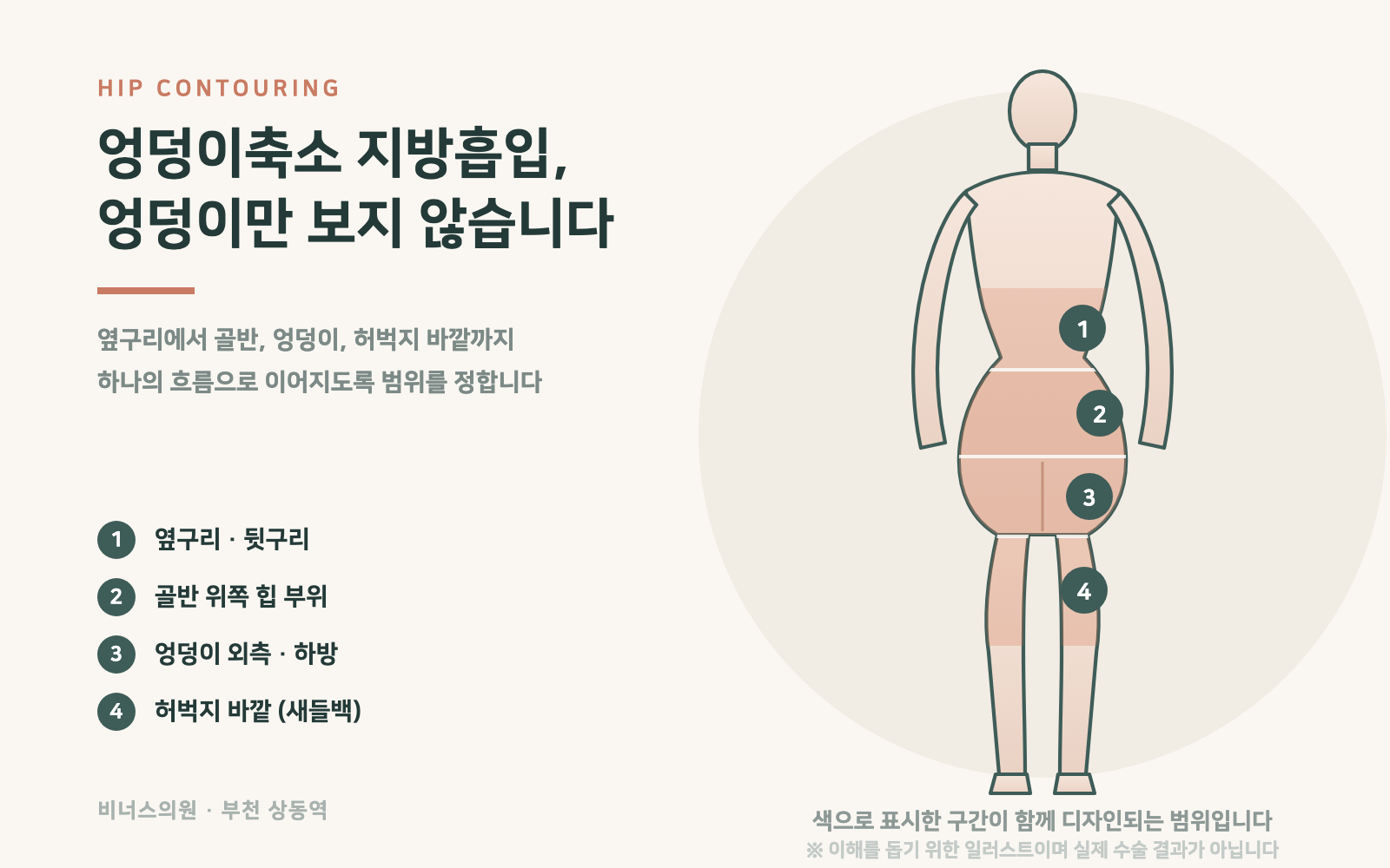 엉덩이축소 지방흡입 범위 인포그래픽 — 옆구리, 골반, 엉덩이, 허벅지 통합 디자인 4단계