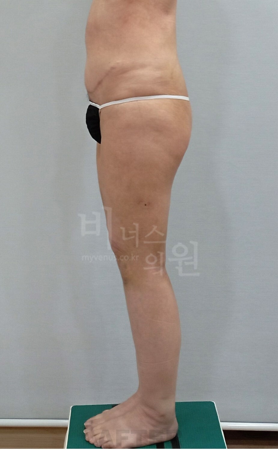 엉덩이축소 지방흡입 수술 후 우측면 비너스의원