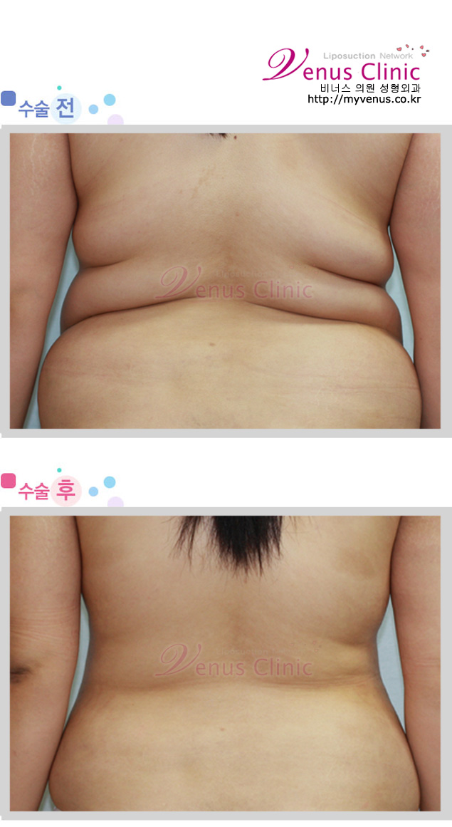 등과 팔지방흡입 전후사진