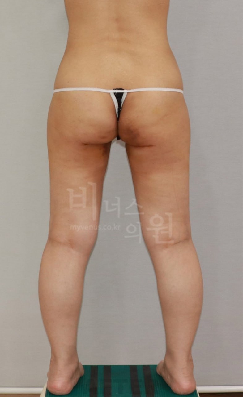 엉덩이 지방흡입 수술 후 후면 비너스의원